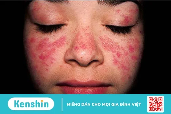 Lupus ban đỏ dạng đĩa có ngứa không? 2