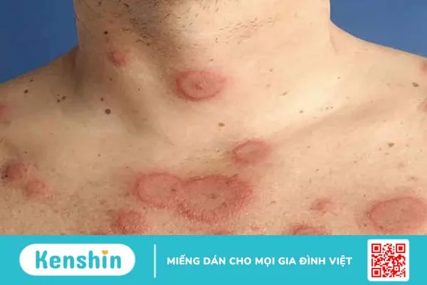 Lupus ban đỏ là gì? Lupus ban đỏ nên khám ở đâu? 1