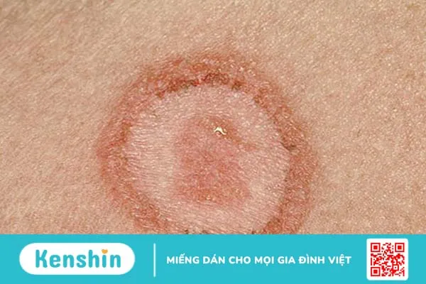 Lupus ban đỏ là gì? Lupus ban đỏ nên khám ở đâu? 2