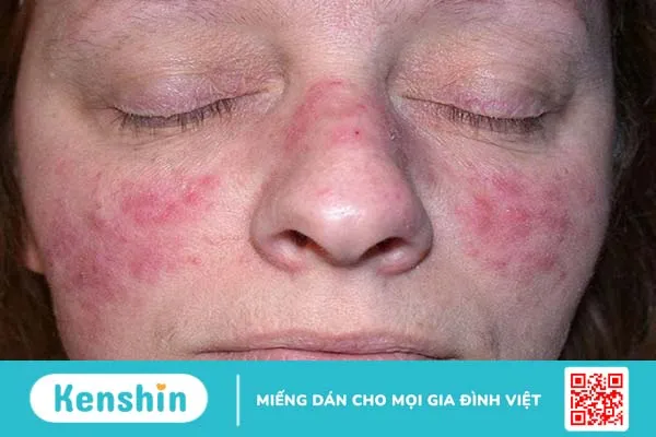 Lupus ban đỏ là gì? Lupus ban đỏ nên khám ở đâu? 3