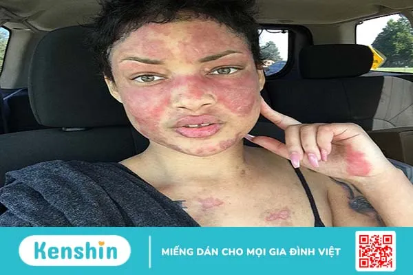 Lupus ban đỏ miễn dịch có nguy hiểm không? Làm sao để giảm căng thẳng khi mắc bệnh 1