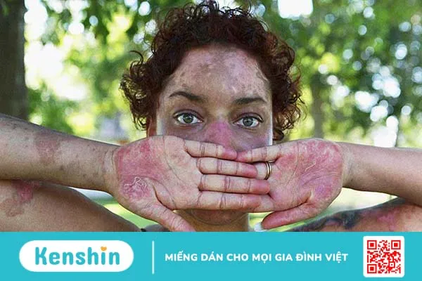 Lupus ban đỏ miễn dịch có nguy hiểm không? Làm sao để giảm căng thẳng khi mắc bệnh 2