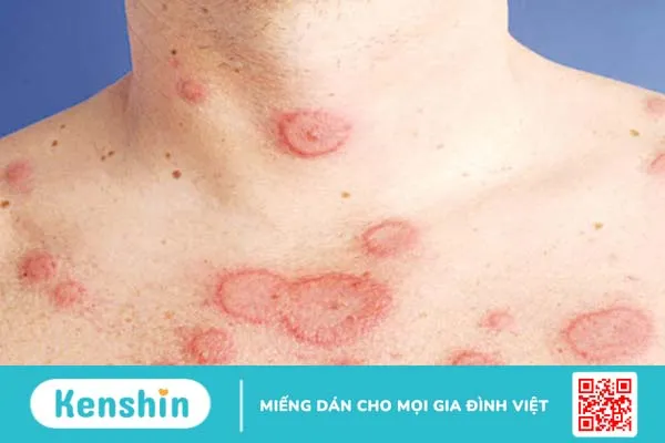 lupus ban đỏ ở cổ có nguy hiểm không? 1