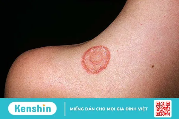 lupus ban đỏ ở cổ có nguy hiểm không?