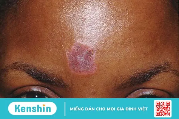 Lupus ban đỏ ở mặt có các dạng tổn thương nào? Chế độ dinh dưỡng cần thiết cho người mắc bệnh lupus ban đỏ 1