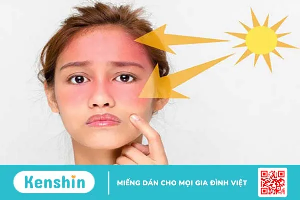 Lupus ban đỏ ở mặt có các dạng tổn thương nào? Chế độ dinh dưỡng cần thiết cho người mắc bệnh lupus ban đỏ 2