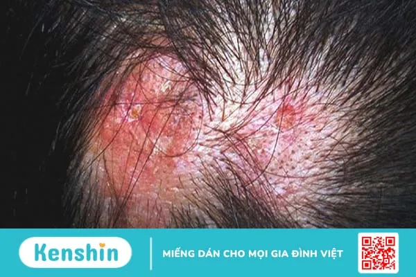 Lupus ban đỏ rụng tóc có nguy hiểm không? Làm thế nào để hạn chế tình trạng này? 1