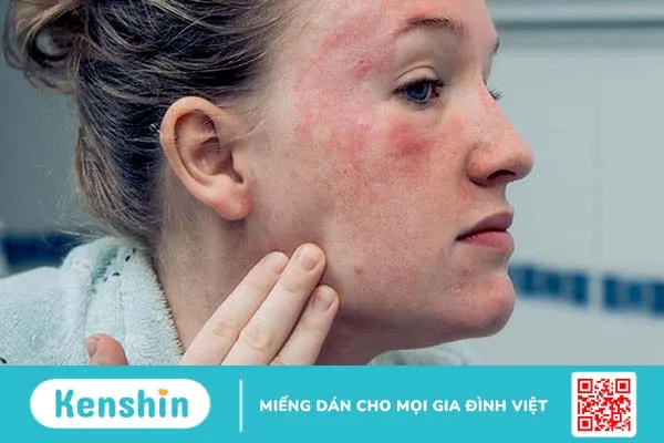 Lupus ban đỏ rụng tóc có nguy hiểm không? Làm thế nào để hạn chế tình trạng này? 2