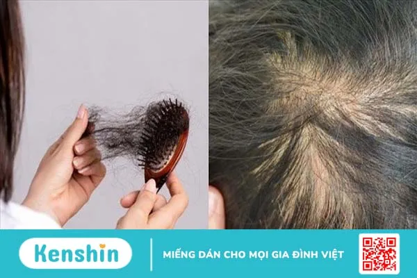 Lupus ban đỏ rụng tóc có nguy hiểm không? Làm thế nào để hạn chế tình trạng này? 3