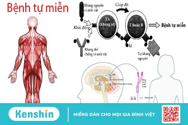 Lupus ban đỏ và vảy nến: Tổng quan và các triệu chứng 1