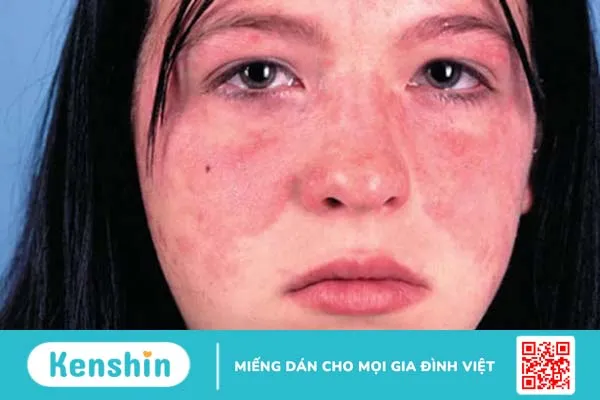 Lupus ban đỏ và vảy nến: Tổng quan và các triệu chứng 2