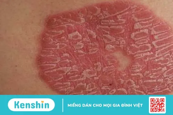 Lupus ban đỏ và vảy nến: Tổng quan và các triệu chứng 3