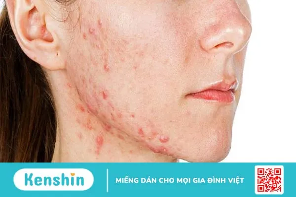 Lưu ý những thành phần dễ gây dị ứng trong mỹ phẩm 1