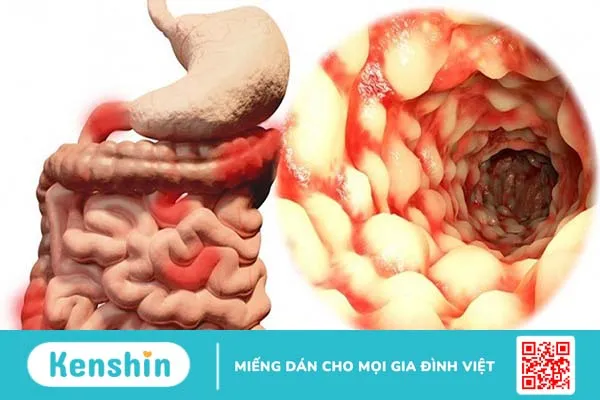 Bệnh Crohn là một bệnh gây viêm ruột và nguyên nhân của nó vẫn chưa được biết rõ