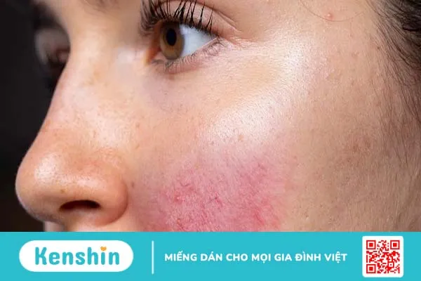 Mách bạn những loại kem trị dị ứng mỹ phẩm giúp da nhanh hồi phục 1