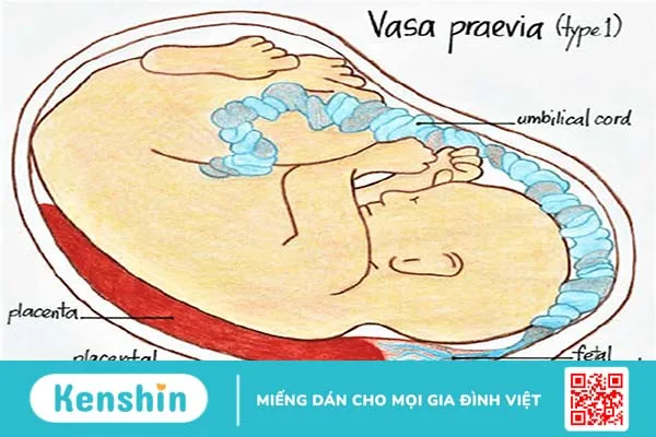 Mạch máu tiền đạo gây ảnh hưởng đến thai nhi như thế nào? 1