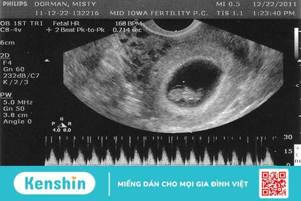 Mạch máu tiền đạo gây ảnh hưởng đến thai nhi như thế nào? 2