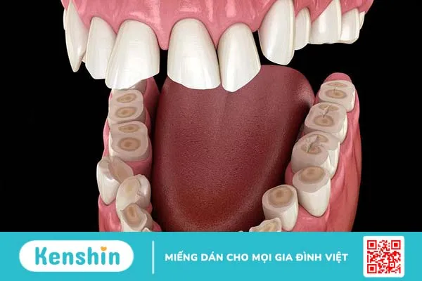 Mài răng đau không? Những điều cần biết về kỹ thuật mài răng trong nha khoa 2