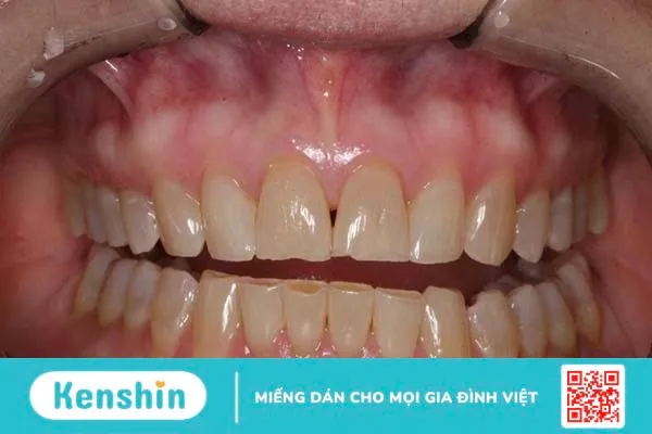 Mài răng đau không? Những điều cần biết về kỹ thuật mài răng trong nha khoa 3