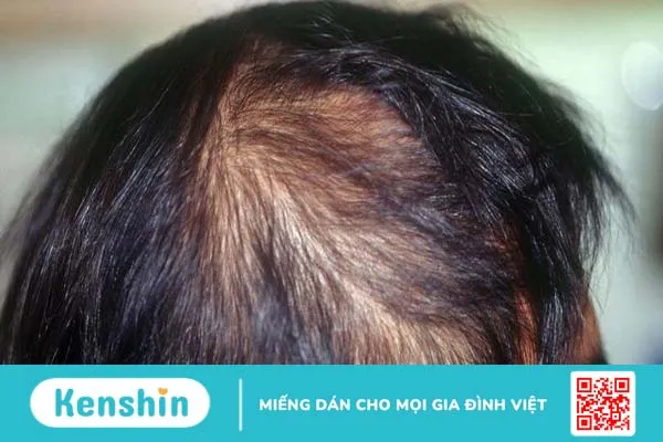 Mất chân tóc có mọc lại không? Phương pháp giúp tóc mọc nhanh hơn 1