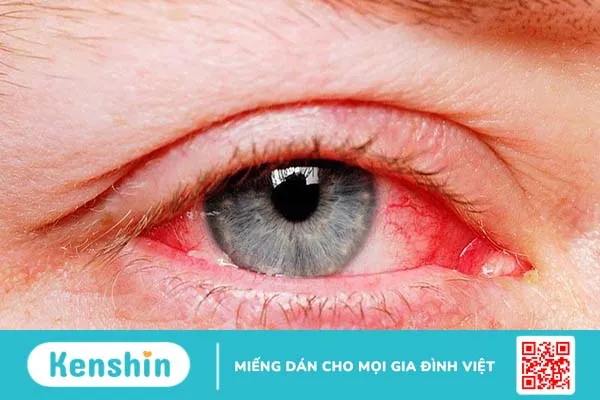 Mắt đổ ghèn: Nguyên nhân và cách điều trị 2