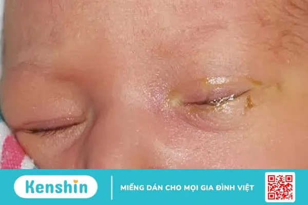 Mắt đổ ghèn: Nguyên nhân và cách điều trị 3