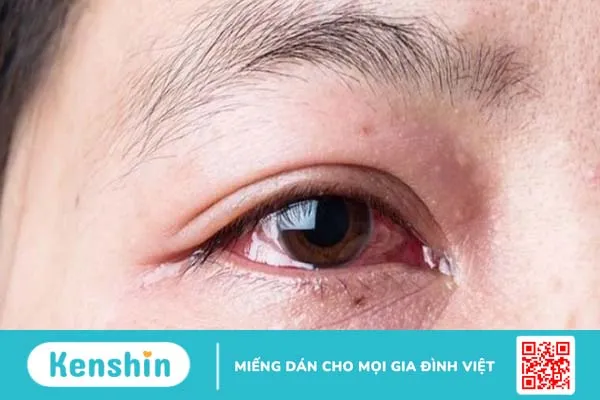 Mắt đỏ khi bị Covid có thể là triệu chứng mới cần lưu ý 2