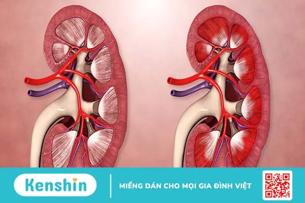 Máu trong nước tiểu: Nguyên nhân và cách điều trị 2