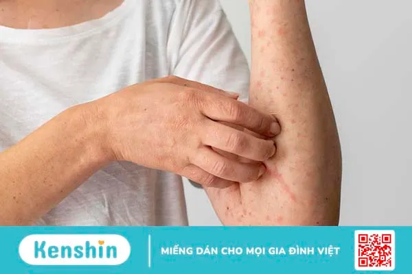 Maxitrol có dùng được cho bà bầu không? Cần lưu ý gì khi sử dụng Maxitrol? 3