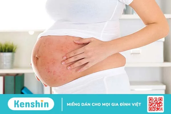 Mày đay mãn tính có bầu được không? Mẹ và bé dễ gặp những nguy cơ gì 2