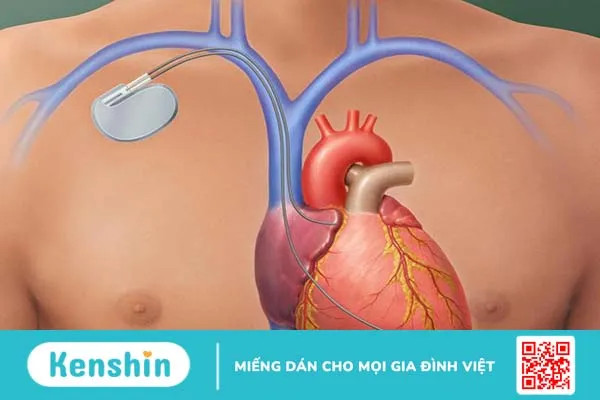 Máy khử rung tim và những điều cần lưu ý 1