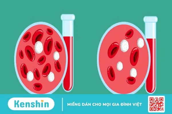 Việc nhận định thiếu máu được phát hiện qua các xét nghiệm