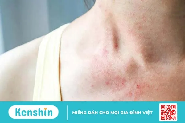 Mẹo chăm sóc da trước trong và sau khi xạ trị 2