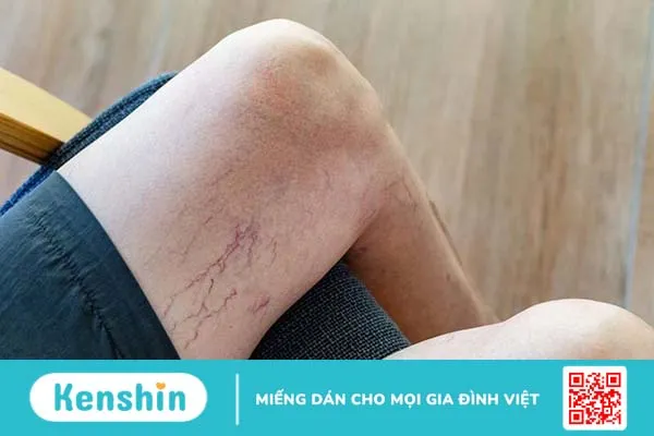 Mẹo chữa suy giãn tĩnh mạch chân khi mang thai an toàn cho mẹ bầu 2