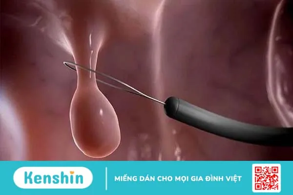 Mổ polyp tử cung bao lâu mới có thai 2