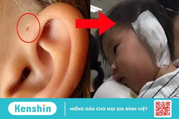 Mổ rò luân nhĩ bao lâu thì khỏi? Nằm viện bao lâu? Chi phí bao nhiêu? 2