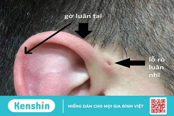 Mổ rò luân nhĩ bao lâu thì khỏi? Nằm viện bao lâu? Chi phí bao nhiêu? 3