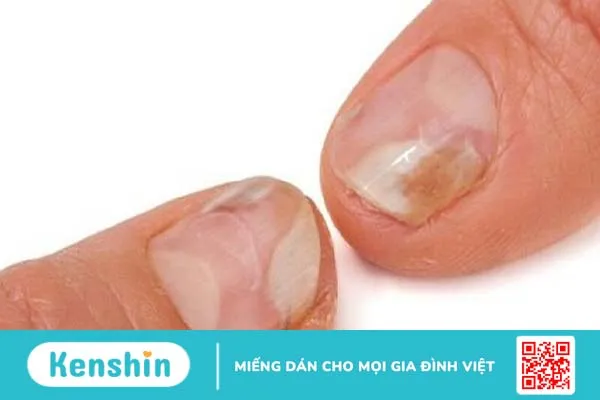 Móng tay bị hư và cách xử lý an toàn, hiệu quả 2