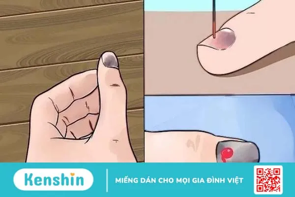 Móng tay bị hư và cách xử lý an toàn, hiệu quả 4