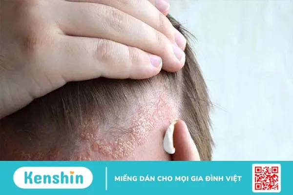 Các triệu chứng nấm da đầu có thể bao gồm xuất hiện các mảng hói cục bộ, da đóng vảy và ngứa