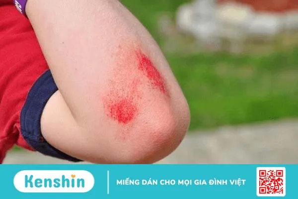 Một số lưu ý cần biết khi chăm sóc vết thương hở tại nhà 1