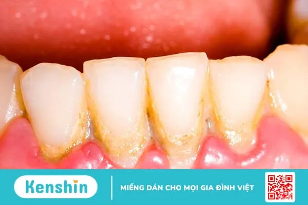 Mảng bám hình thành trên bề mặt và kẽ răng