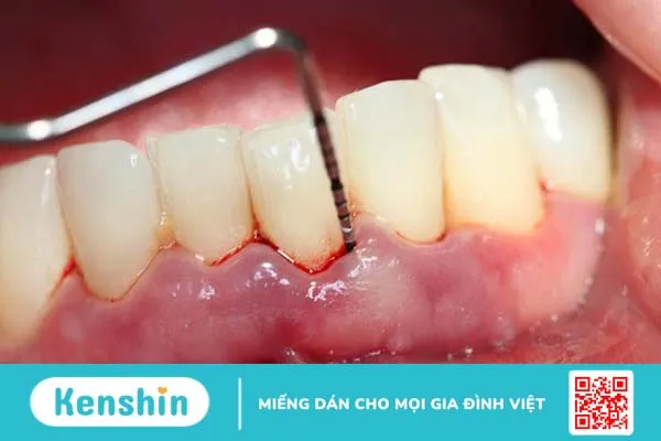 Viêm nha chu do mảng bám trên răng