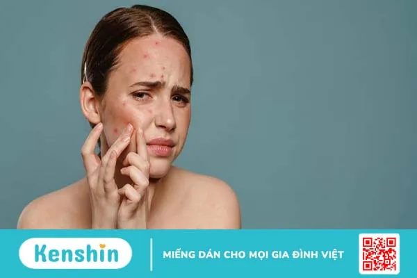 Mụn đỏ ở má 03