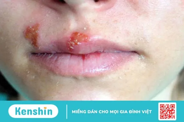 Mụn rộp sinh dục nam: Nguyên nhân và cách phòng ngừa 2