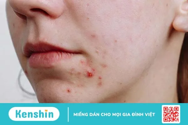 Mụn thâm tụ máu là gì? Cách điều trị mụn thâm tụ máu hiệu quả? 1