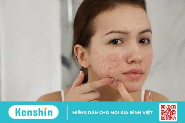 Mụn thâm tụ máu là gì? Cách điều trị mụn thâm tụ máu hiệu quả? 2