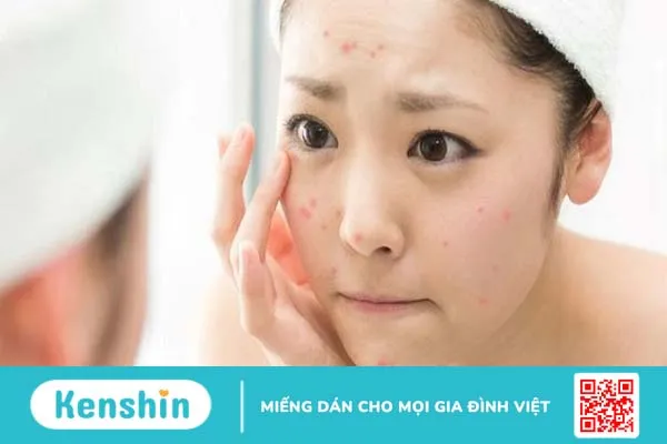 Mụn thâm tụ máu là gì? Cách điều trị mụn thâm tụ máu hiệu quả? 3