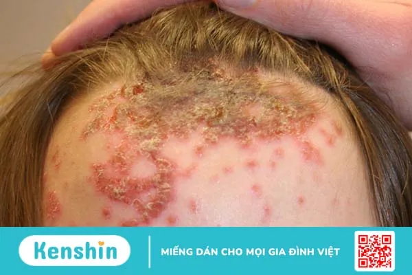 Muôn vàn câu hỏi về bệnh chốc lở da đầu ở trẻ em 1