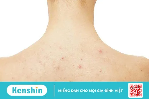 Nacurgo gel trị viêm nang lông hiệu quả không?